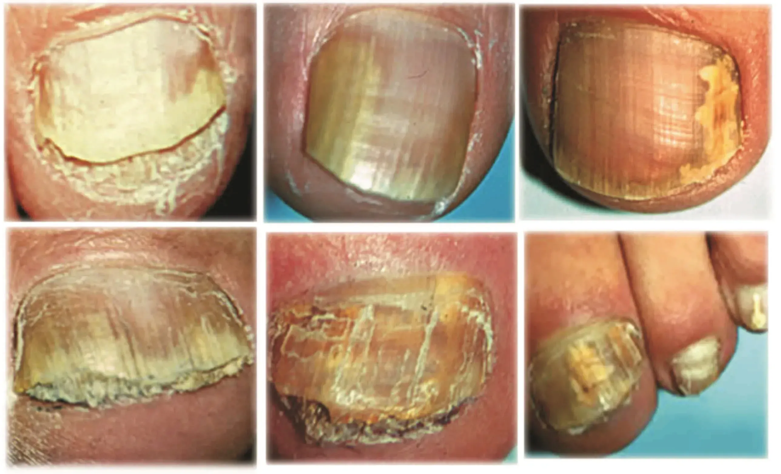 Exofeet oil România - recenzii - comentarii - pareri - ce este - preț - compoziție - cumpără - in farmacii.